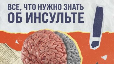 Все, что нужно знать об инсульте